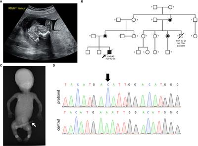 Perturbations in fatty acid metabolism and collagen production infer pathogenicity of a novel MBTPS2 variant in Osteogenesis imperfecta